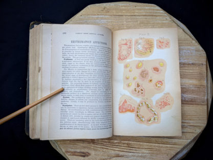 erythematous affections illustraion - 1895 The Peoples Common Sense Medical Adviser by R.V. Pierce M.D.